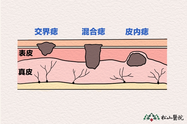 痣的類型。重慶松山醫(yī)院供圖