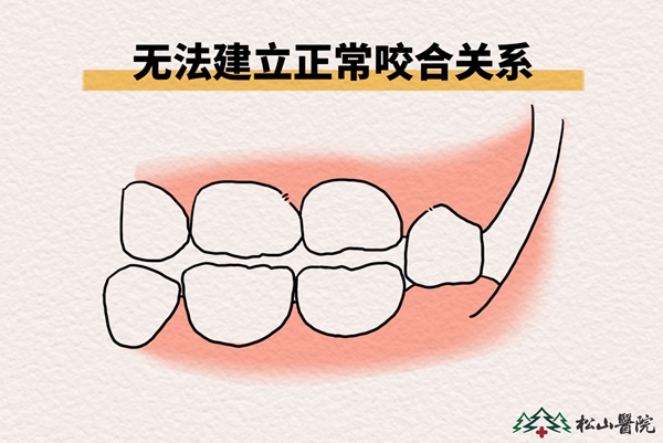 無(wú)法建立正常咬合關(guān)系。重慶松山醫(yī)院供圖